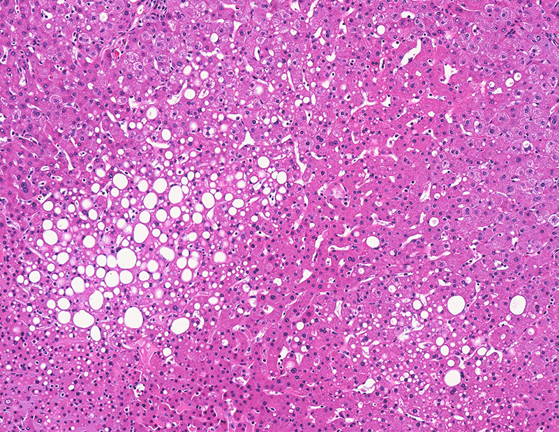 Fatty Liver